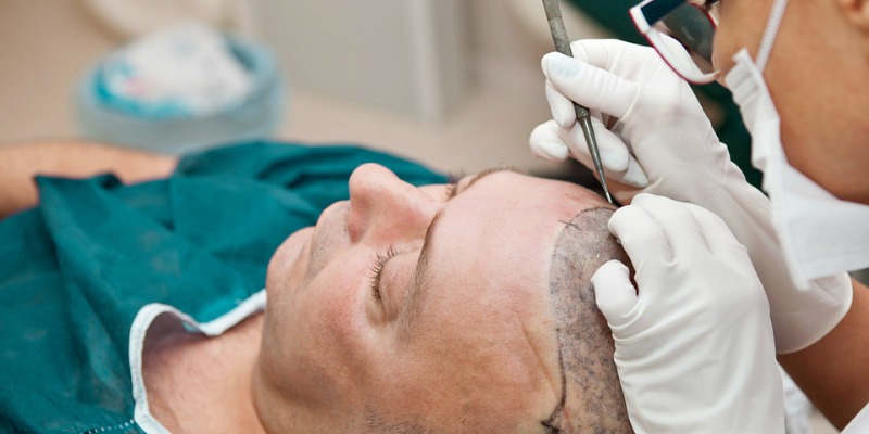Sapphire Hair Clinic Hair Transplant Istanbul for Men &amp; Women